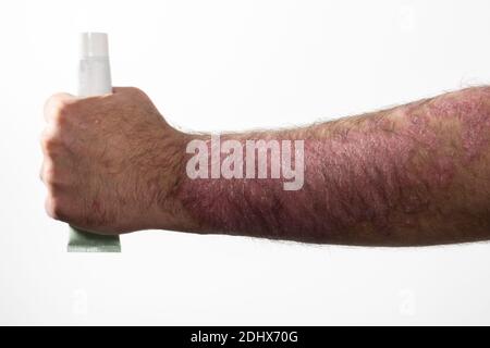 Homme avec le psoriasis malade de la main (eczéma) et d'autres maladies de la peau telles que le champignon, tenant dans sa main pommade tube pour la peau sèche et feuilletée, comme traitement, wh Banque D'Images