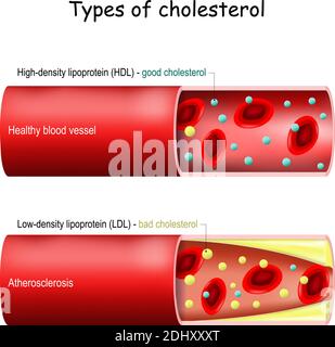 Types de cholestérol. Bon (HDL) et mauvais (LDL) cholestérol. Vaisseau sanguin sain et athérosclérose. Coupe transversale du vaisseau sanguin avec les érythrocytes Illustration de Vecteur