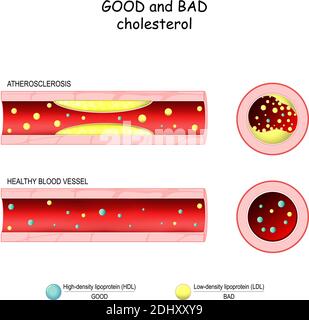 Bon (HDL) et mauvais (LDL) cholestérol. Vaisseau sanguin sain et athérosclérose. Coupe transversale du vaisseau sanguin. Lipoprotéine de faible densité et de haute densité Illustration de Vecteur