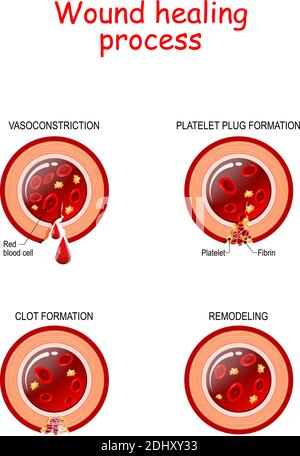 Phases du processus de cicatrisation des plaies. Hémostase, inflammatoire, proliférative, phase de maturation et de remodelage. Affiche sur la coupe transversale du vaisseau sanguin Illustration de Vecteur