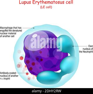 Lupus érythémateux. Structure de LA cellule LE. Anatomie humaine gros plan du neutrophile ou du macrophage qui a englouti la matière nucléaire dénaturée Illustration de Vecteur