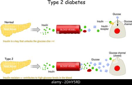 Types 2 de diabète sucré. Comparaison du travail cellulaire dans le diabète et dans un corps sain. La résistance à l'insuline contribue à des niveaux élevés de glucose Illustration de Vecteur
