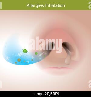 Allergies inhalation. L'illustration montre le nez humain de près de la réaction la réponse du système immunitaire. Illustration de Vecteur