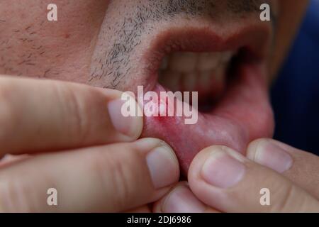 détail de la bouche de l'homme avec ulcère douloureux sur sa lèvre inférieure, foyer doux Banque D'Images