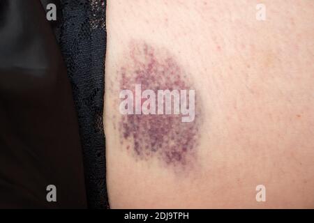 ecchymose bleue et rose sur la cuisse femelle en gros plan Banque D'Images