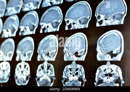 Acquisition d'image par résonance magnétique d'un cerveau humain avec un kyste colloïde. Film IRM d'une tumeur du cerveau et du crâne humain. Antécédents de neurologie. Médecine, science. Banque D'Images