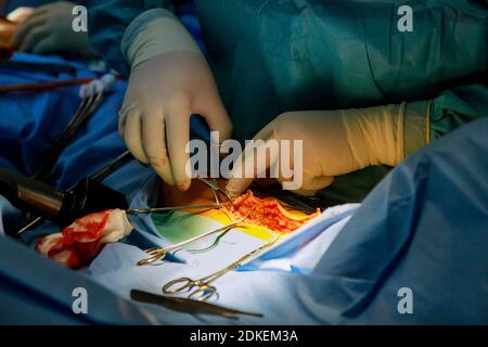 Instruments médicaux avec le médecin dans la salle d'opération, le chirurgien effectue une opération sur la jambe du patient, coupe la peau avec un scalpel mains Banque D'Images