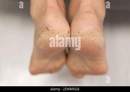 Craques de callus sanglants sur un pied de talon de semelle de près. Problème de dermatologie de la peau sèche Banque D'Images