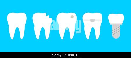 Dents avec différentes maladies. Dent saine, craquelée, broken, avec caries, orthodontiques et implant dentaire Illustration de Vecteur