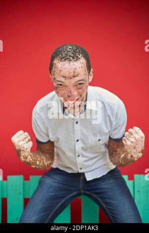 Jeune homme avec vitiligo sur un banc vert Banque D'Images