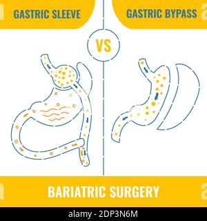 Chirurgie bariatrique, illustration conceptuelle . Banque D'Images