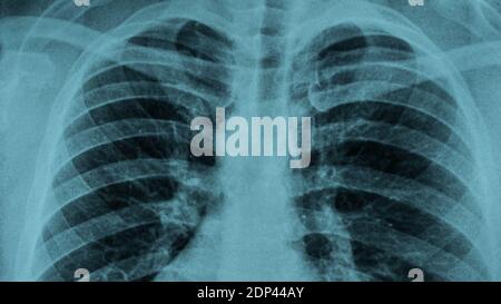 Radiographie des poumons humains en gros plan Banque D'Images