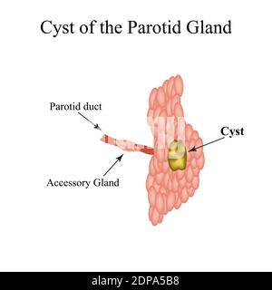 Kyste de la glande paratide salivaire. Structure de la glande salivaire parotide. Illustration vectorielle sur un arrière-plan isolé Illustration de Vecteur