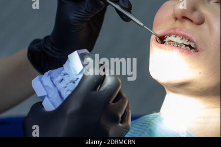 Une femme avec des bretelles sur ses dents visite un orthodontiste assis dans une chaise dentaire. Pendant la procédure d'installation de la voûte des bretelles sur le Banque D'Images