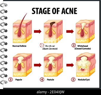 Étapes de l'illustration de l'anatomie de l'acné de peau Illustration de Vecteur