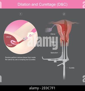 Dilatation et curetage. Les médecins effectuent retirer les tissus de l'intérieur de l'utérus à l'aide d'un outil de raclage. Illustration de Vecteur