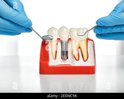 Notion : prothèses dentaires. Montrant l'installation d'un implant dentaire sur le modèle anatomique des dents, en gros plan Banque D'Images