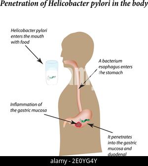 Infection par Helicobacter pylori. Infographies. Illustration vectorielle sur un arrière-plan isolé Illustration de Vecteur
