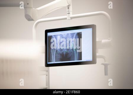 image d'une radiographie de la hanche sur un écran dans un salle d'opération Banque D'Images