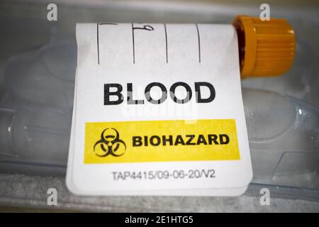 échantillon de sang marqué sang et risque biologique pour l'anticorps commercial covid-19 kit de test sanguin pour le dépistage à domicile des anticorps du coronavirus reçus au royaume-uni Banque D'Images