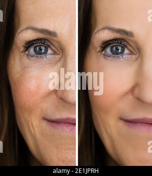 Anti rajeunissement rides lever avant et après Banque D'Images