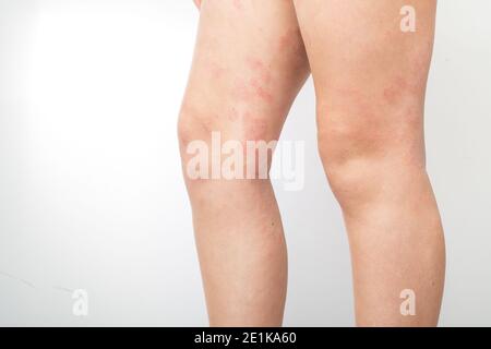 La dermatite atopique aiguë sur les pieds d'un enfant est une maladie dermatologique de la peau. Grande éruption cutanée rouge, enflammée et squameuse sur les jambes. Jambes d'un adolescent avec Banque D'Images