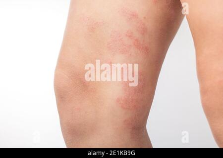 L'eczéma atopique sévère sur les jambes d'un enfant est une maladie dermatologique de la peau. Grande éruption cutanée rouge, enflammée et squameuse sur les jambes. Jambes d'un adolescent Banque D'Images