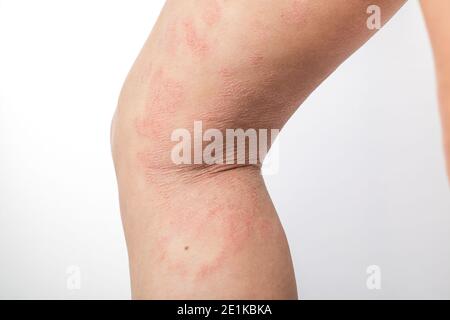 L'eczéma atopique sévère sur les jambes d'un enfant est une maladie dermatologique de la peau. Grande éruption cutanée rouge, enflammée et squameuse sur les jambes. Jambes d'un adolescent Banque D'Images