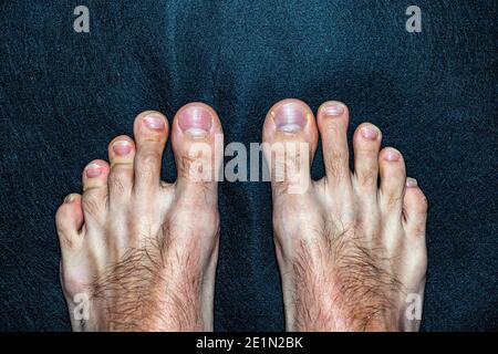 pieds callotés et sales d'un homme avec des ongles longs et sales de doigt. Banque D'Images