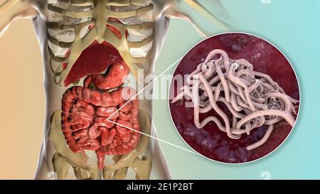 Vers ronds dans l'intestin humain, illustration Banque D'Images
