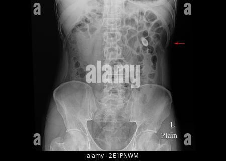 Film radiographique d'un patient présentant plusieurs calculs rénaux. Banque D'Images