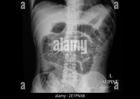 Film radiographique abdominal en décubitus dorsal d'un patient mâle présentant une obstruction intestinale mécanique. Banque D'Images