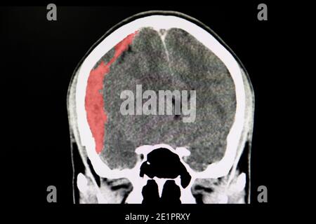 Une tomodensitométrie du cerveau d'un patient présentant un accident de la circulation montrant un hématome subdural aigu. Banque D'Images