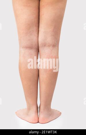 Jambes d'un adolescent atteint d'eczéma atopique sévère. La dermatite atopique aiguë sur les jambes d'un enfant est une maladie dermatologique de la peau. Grand, rouge, infl Banque D'Images