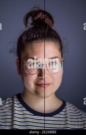 Jolie fille avec des lunettes et des problèmes de peau du visage. Avant et après le traitement médical Banque D'Images