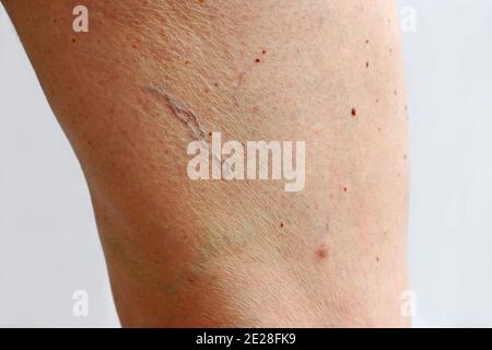 Veines d'araignées, varices et cellulite sur la jambe d'une femme Banque D'Images