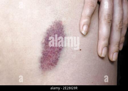 Un hématome sur la jambe d'une femme. Une grande ecchymose sur la peau d'un humain Banque D'Images