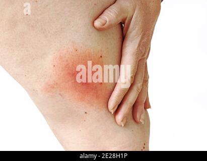 Rougissement d'une maladie de la borréliose de Lyme transmise par les tiques sur la jambe d'une femme. Rougeur de la peau sur la jambe due à une allergie Banque D'Images