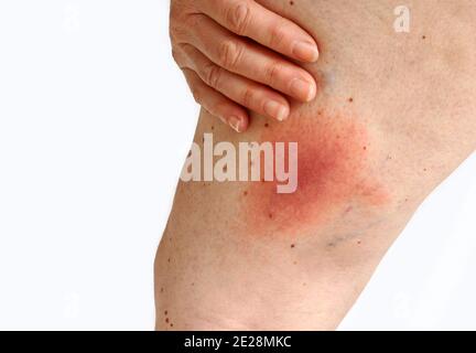 Rougissement d'une maladie de la borréliose de Lyme transmise par les tiques sur la jambe d'une femme. Rougeur de la peau sur la jambe due à une allergie Banque D'Images