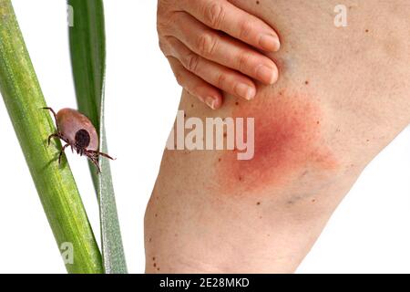 Rougissement d'une maladie de la borréliose de Lyme transmise par les tiques sur la jambe d'une femme. Rougeur de la peau sur la jambe due à une allergie Banque D'Images