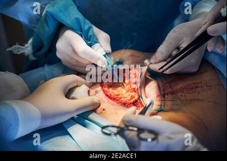 Gros plan d'un chirurgien plasticien et d'assistants effectuant une opération chirurgicale plasticale à l'hôpital, à l'aide d'instruments médicaux. Se concentrer sur la plaie sur l'abdomen du patient. Concept de l'abdominoplastie et de la chirurgie plastique Banque D'Images