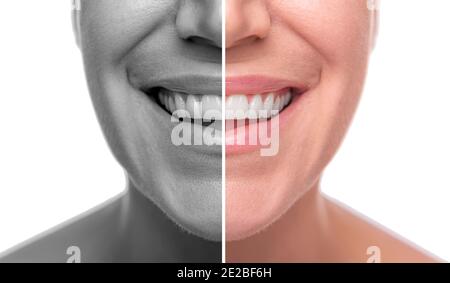 Le visage d'une femme est divisé en deux pour la bonne et la mauvaise peau. Isolé sur fond blanc Banque D'Images