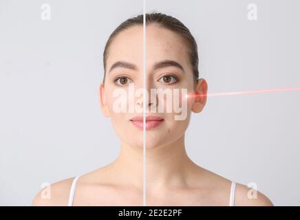 Jeune femme avant et après la procédure de l'élimination de l'acné par laser sur fond clair Banque D'Images