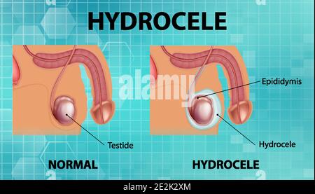 Affiche médicale montrant différents entre le testicule normal mâle et l'hydrocèle illustration Illustration de Vecteur