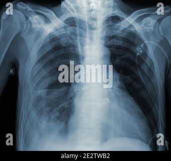 Image de Roentgen du patient dans le service de chirurgie. Banque D'Images