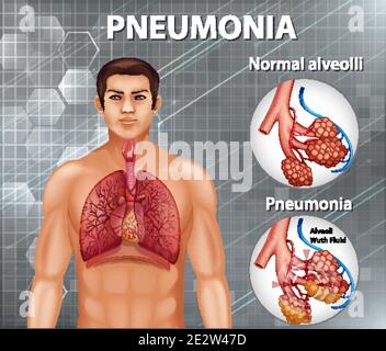 Comparaison de l'alveoli sain et de la pneumonie illustration Illustration de Vecteur