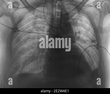 Image radiographique après une chirurgie cardiaque. Banque D'Images