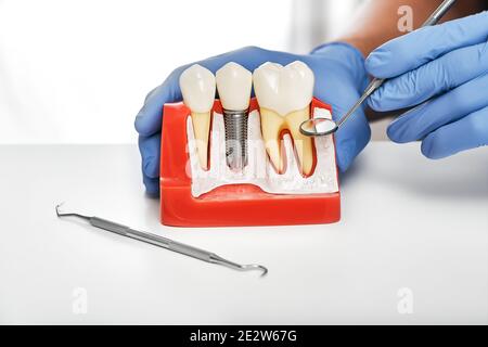 Notion : prothèses dentaires. Montrant l'installation d'un implant dentaire sur le modèle anatomique des dents, macro Banque D'Images