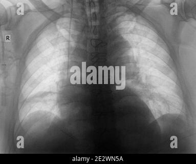 Radiographe thoracique simple du patient après une chirurgie cardiaque. Banque D'Images