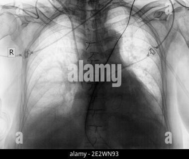 Radiographie thoracique simple du patient après une intervention chirurgicale. Banque D'Images